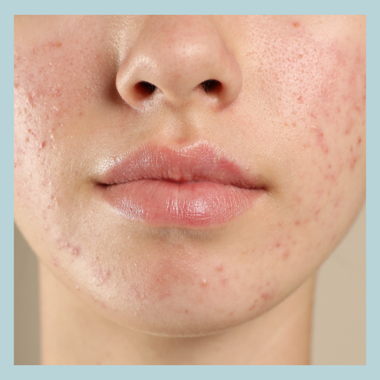 5 Steps to Treat Acne and Fade Acne Marks