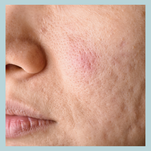 How to Manage Large Pores: Causes, Treatments & Daily Tips