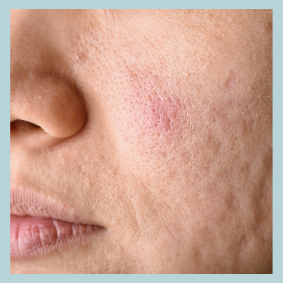 How to Manage Large Pores: Causes, Treatments & Daily Tips